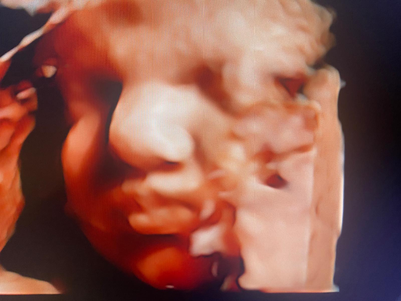 ecografia accrescimento