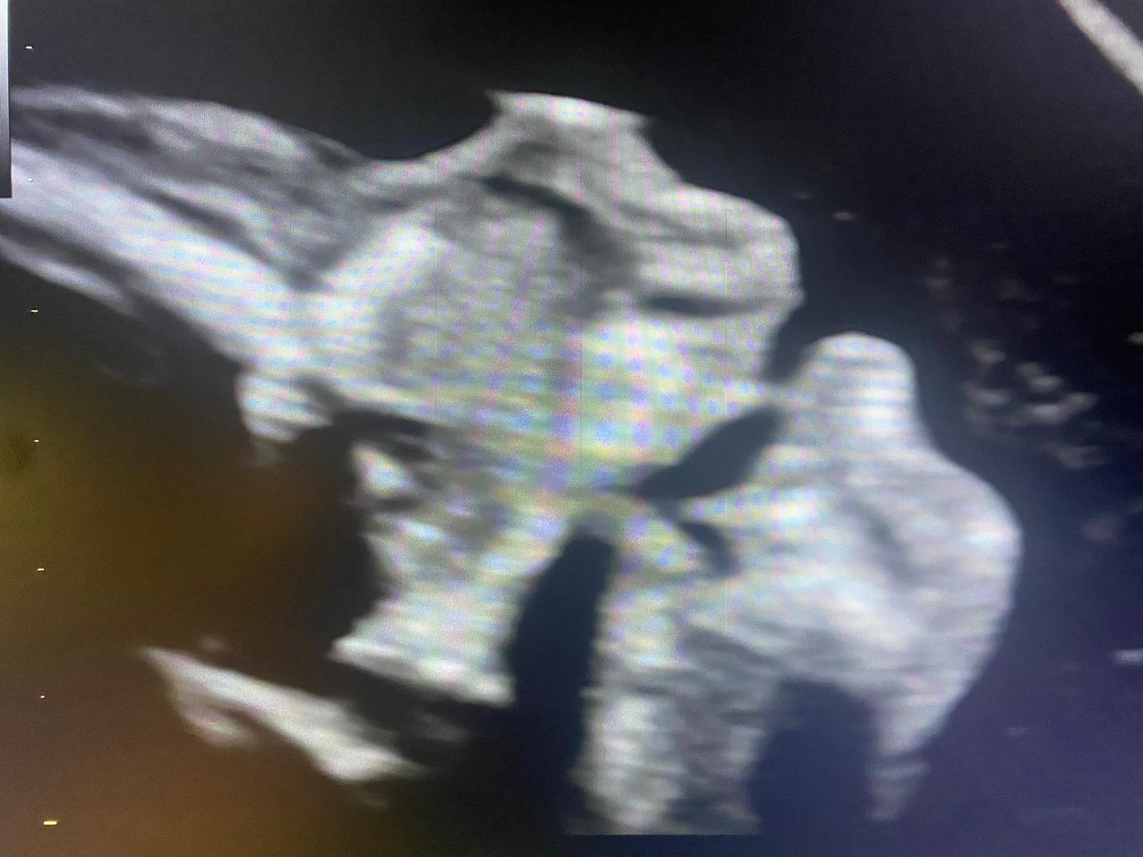 feto secondo trimestre