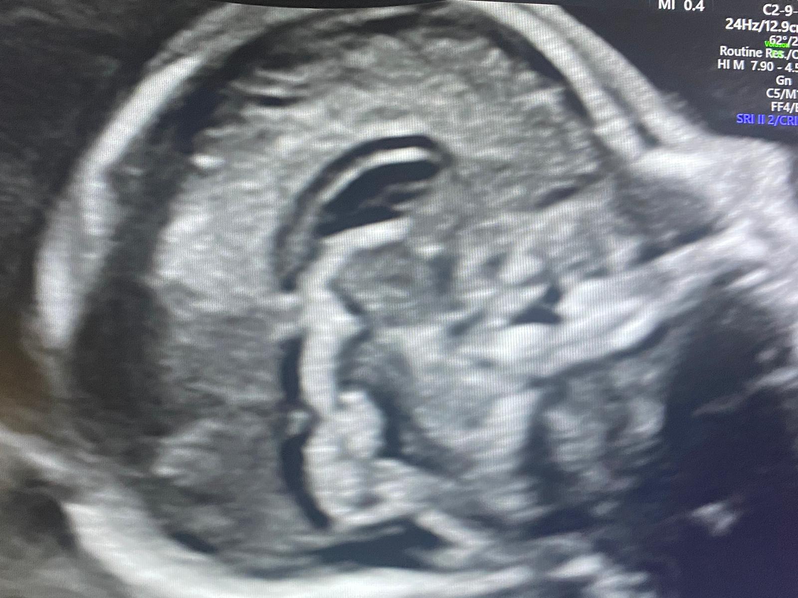 ecografia morfologica 2