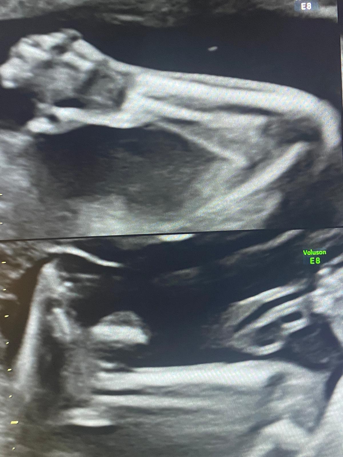 ecografia morfologica 1