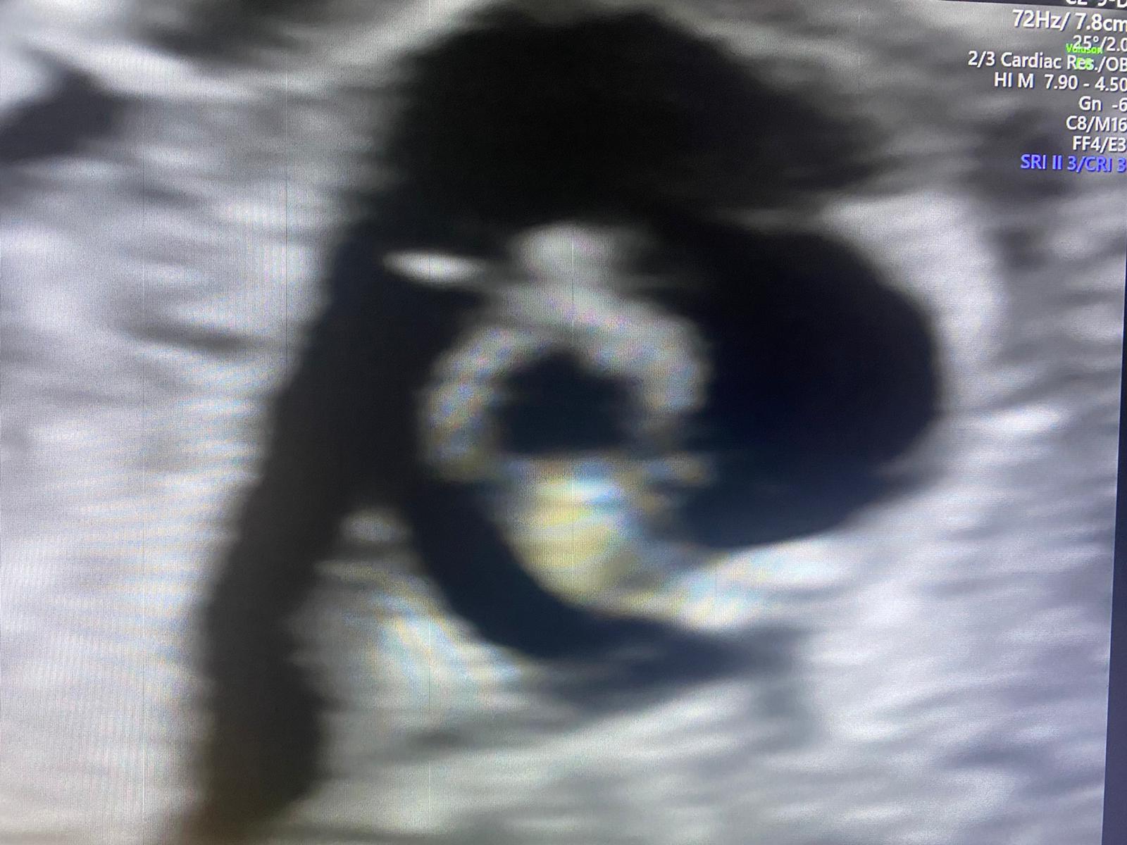 ecografia morfologica feto