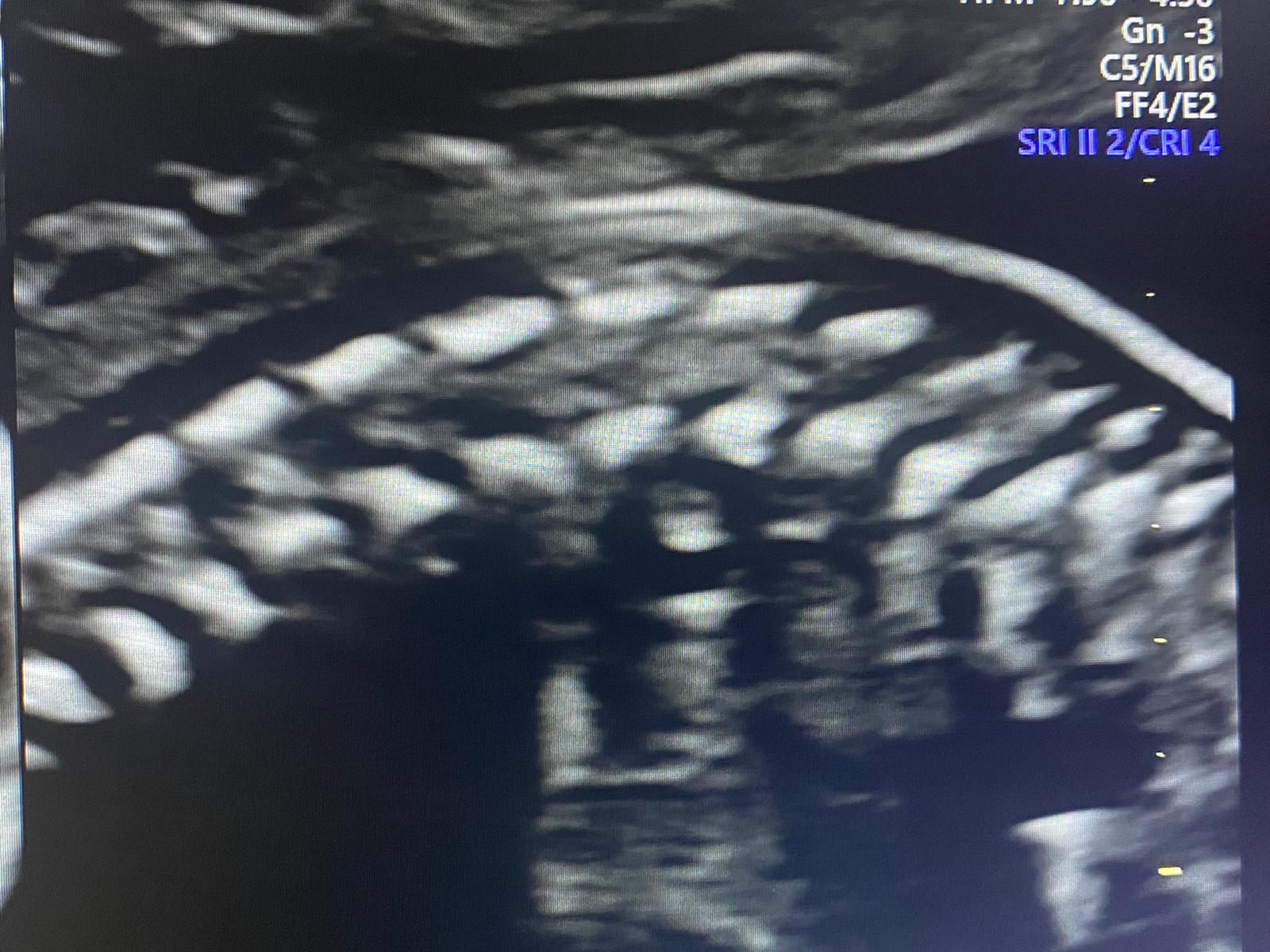 ecografia morfologica spina dorsale