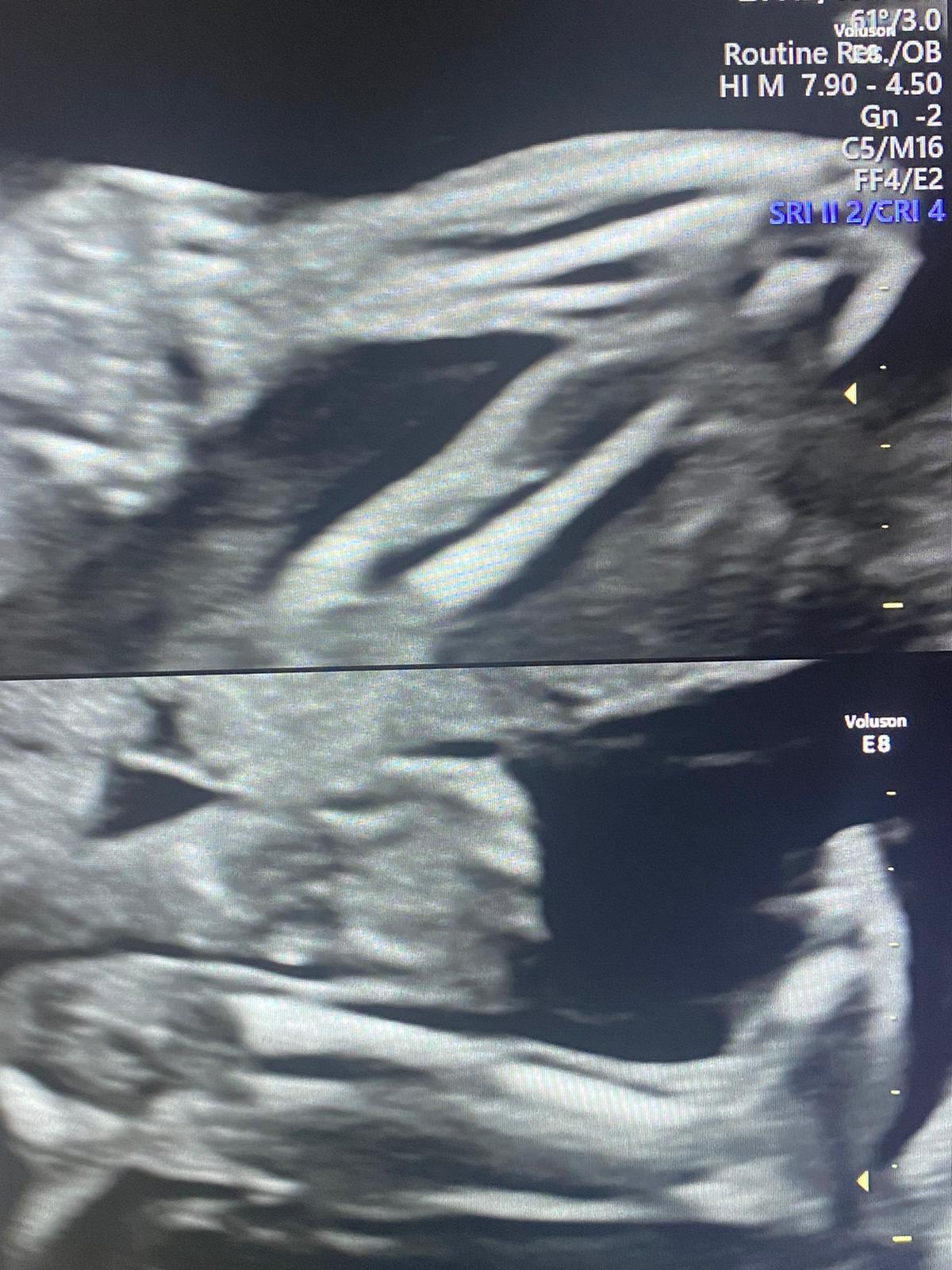 ecografia morfologica arti