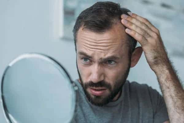 Image of a mans receding hairline