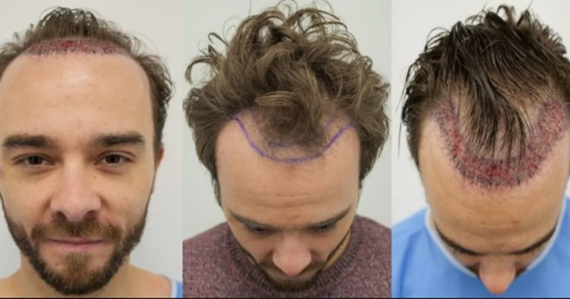 Jack P. Shepherd, best known for playing David Platt in Coronation Street, has once again put hair transplants back into the spotlight after reportedly revealing his latest procedure.
