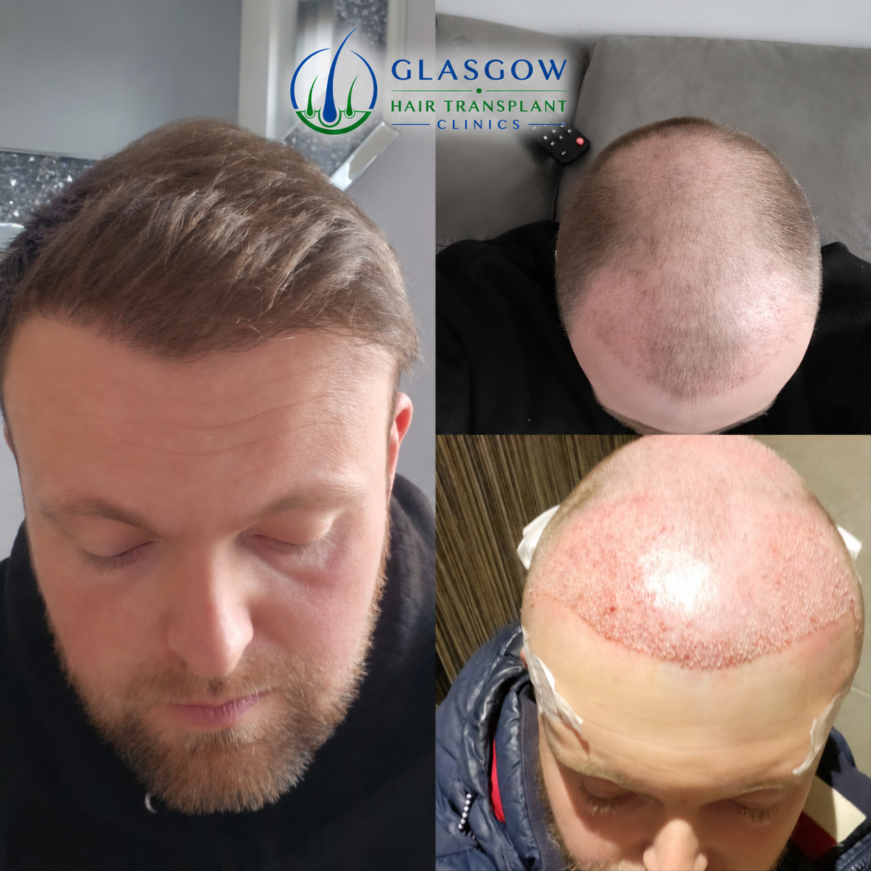 Before and after - FUE hair transplant 