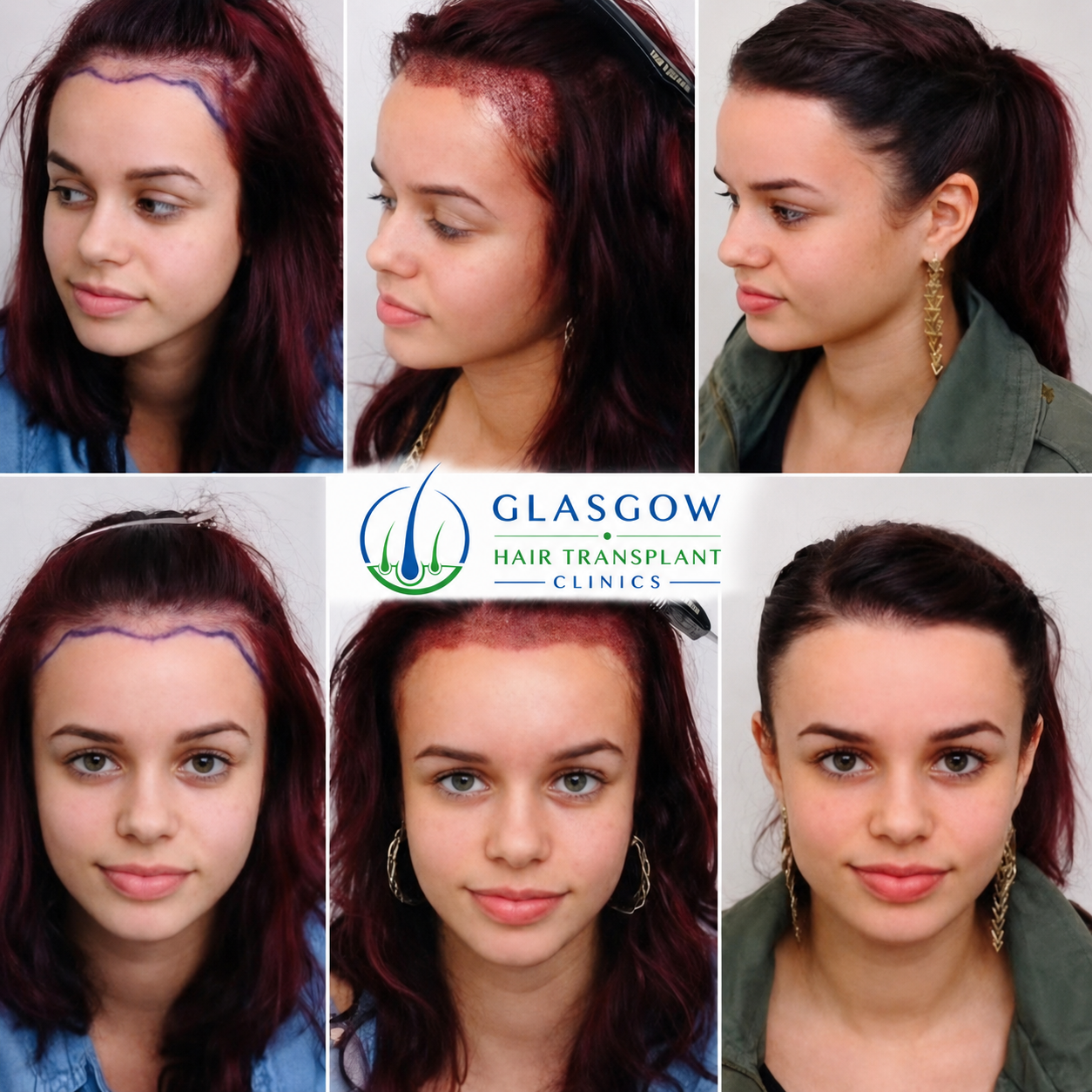 Before and after DHI hair transplant - 13 month's 
