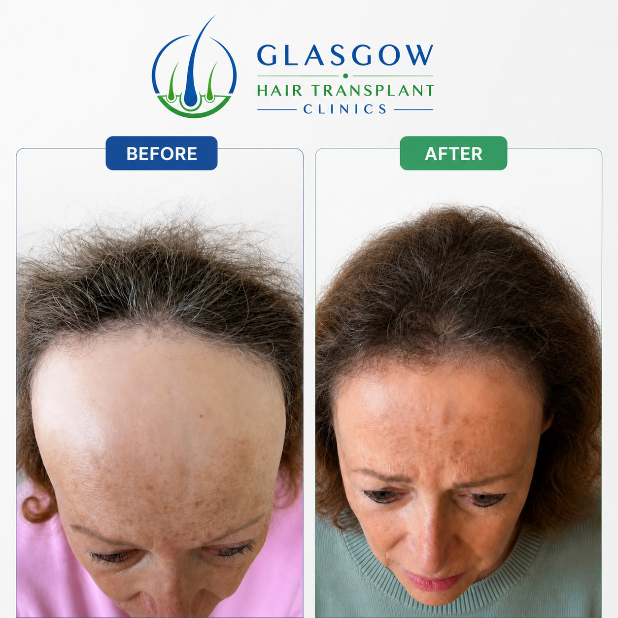 Before and after -female FUE hair transplant 