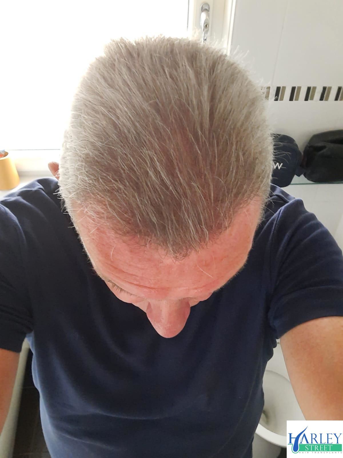 A picture of a male after undergoing a crown hair transplant with Harley street hair transplant Glasgow