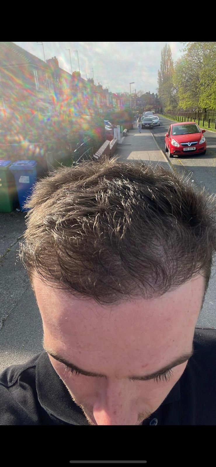 A picture of a FUE hair transplant carried out by Harley Street hair transplant Glasgow