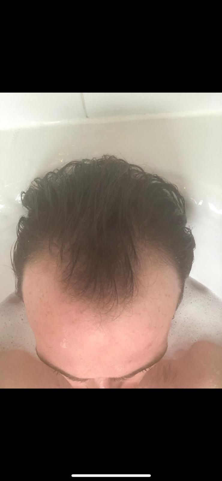 A picture of a hair transplant Glasgow patient showing signs of male pattern baldness