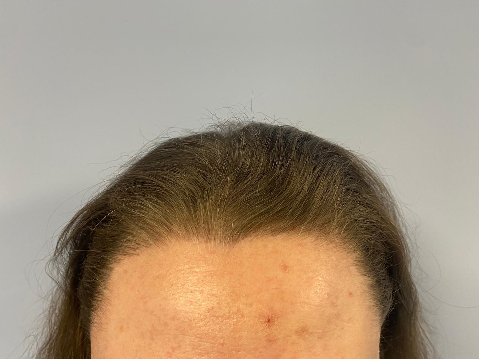 A female patient after undergoing a hair transplant