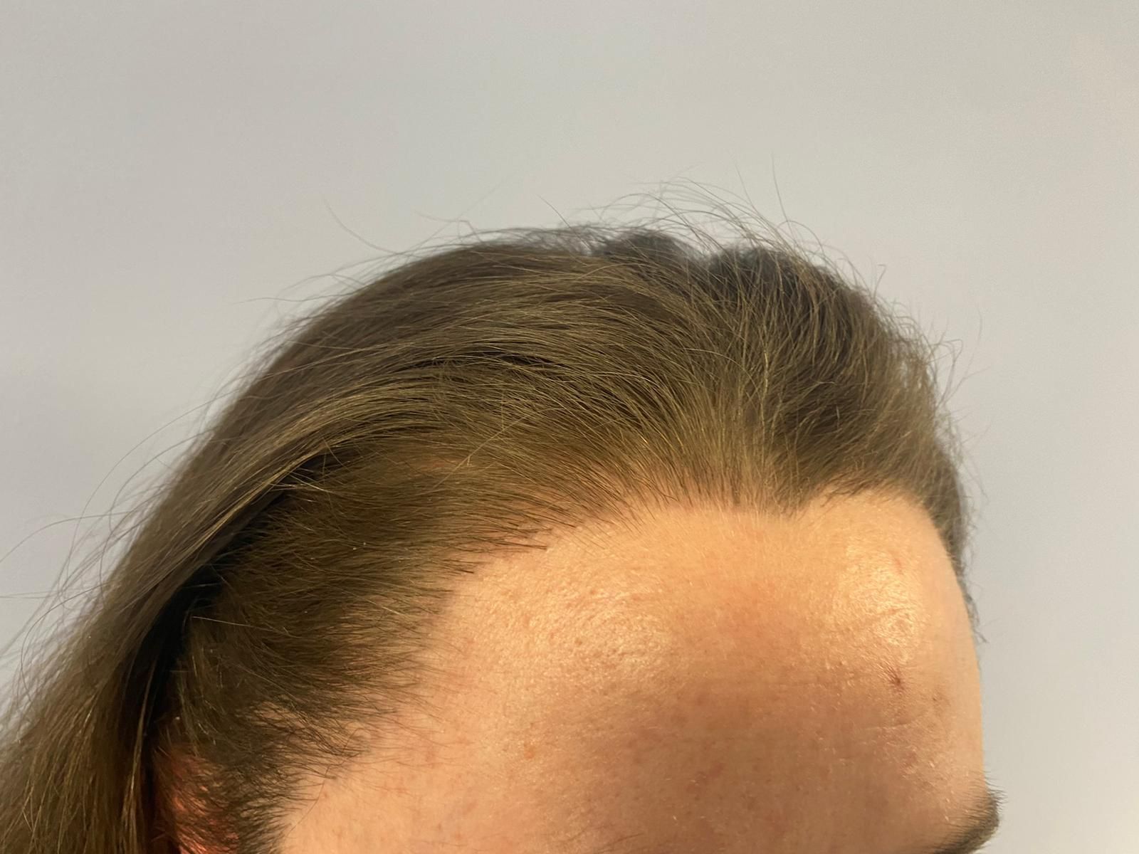 A female patient after undergoing a FUE hair transplant
