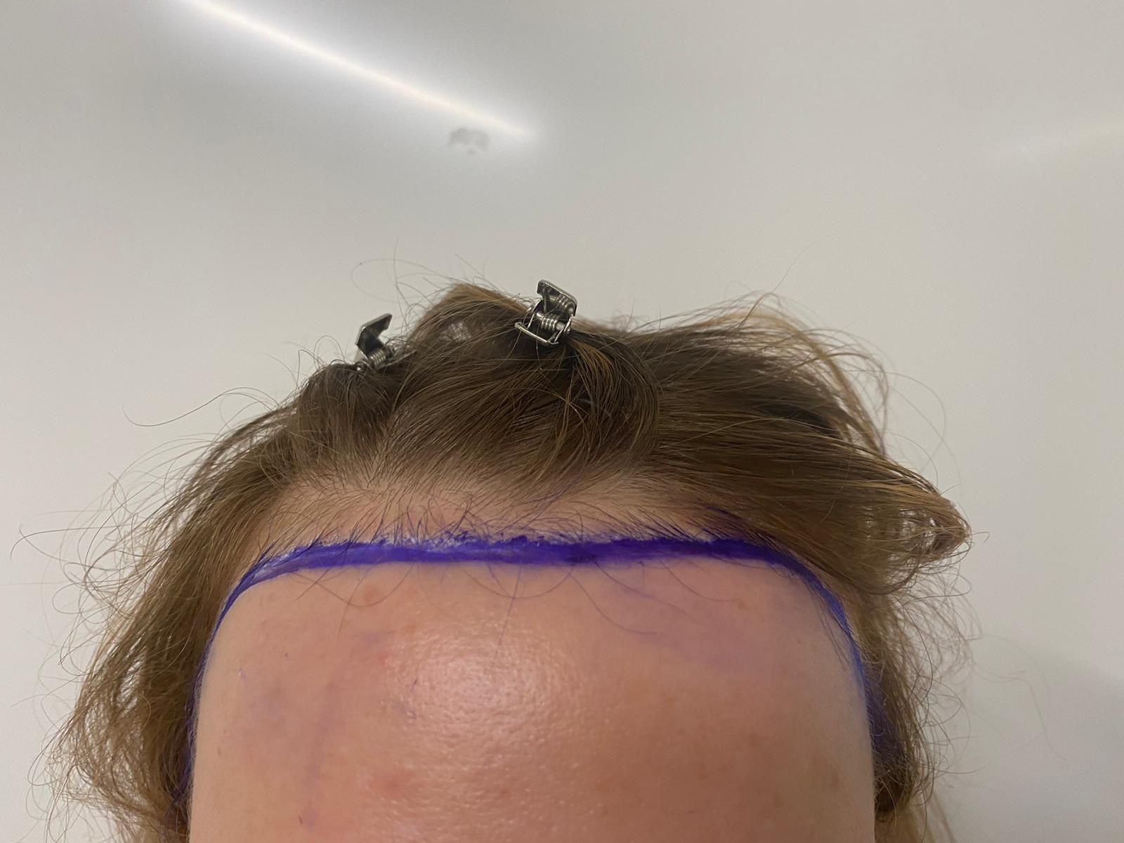 a picture of a female marked up prior to a hair transplant