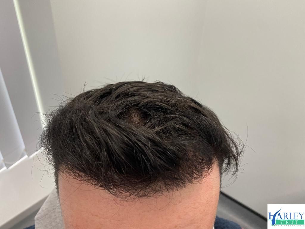 A picture of a hair transplant carried out by Harley Street Hair Transplant Glasgow