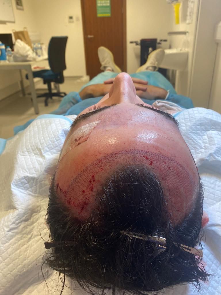 a picture of a male patient undergoing FUE at the Glasgow hair transplant clinic