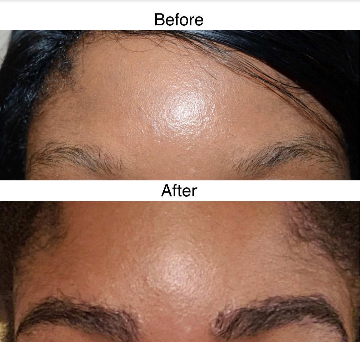 A before and after photo of a female who has had an eyebrow hair transplant with Harley Street Hair Transplant Glasgow