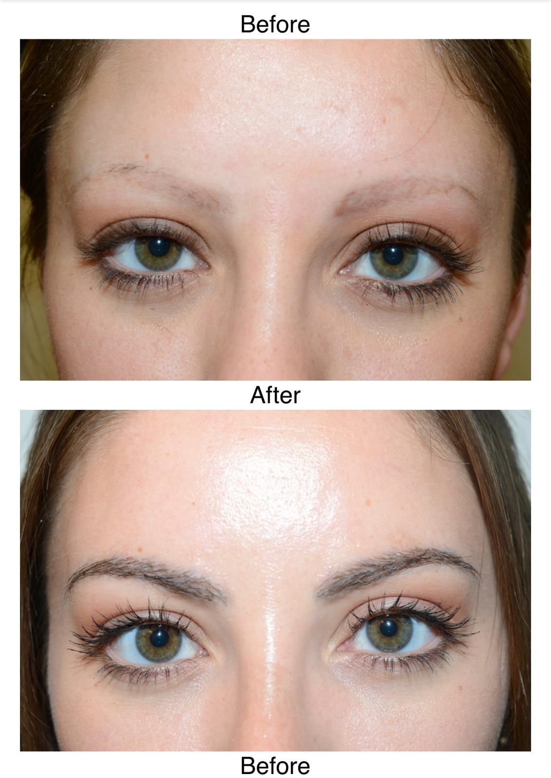 A before and after photo of a female who has had an eyebrow hair transplant with Harley Street Hair Transplant Glasgow