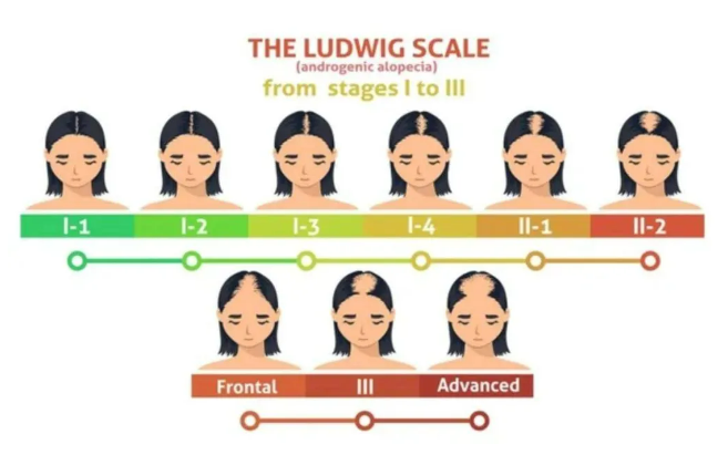 Ludwig scale female pattern hair loss image