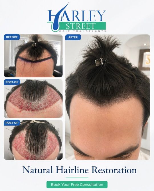 Before and after image of a man having FUE hair transplant on his hairline.
