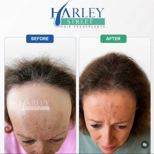 Before and after image of a woman having FUE hair transplant lowering her hairline.