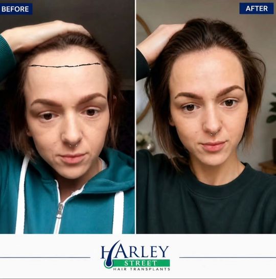 Before and after image of a woman having FUE hair transplant