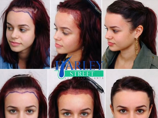 Before and after image of a woman having unshaven FUE hair transplant on her hairline.
