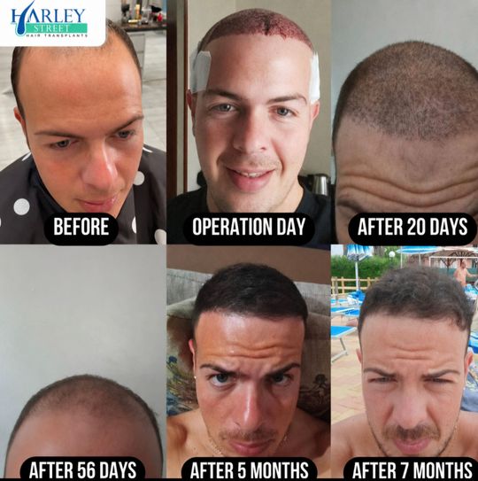 Before and after image of a man having DHI hair transplant on his hairline and mid-scalp.