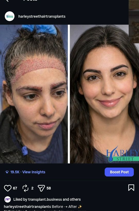 Before and after image of a woman having FUE hair transplant on her hairline and having a eyebrow transplant