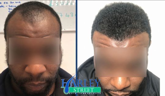 Before and after image of a man having FUE hair transplant Afro hair.