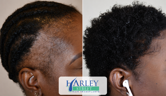 Before and after image of a woman having FUE hair transplant on her sides.