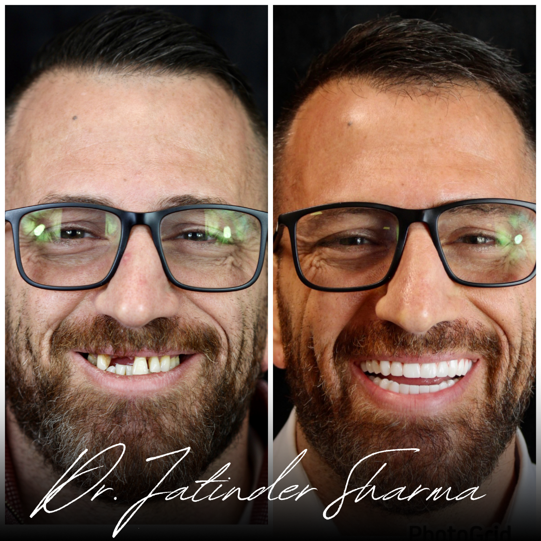 A before and after photo of a man 's face by dr. jatinder sharma