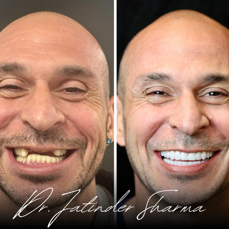 A before and after photo of a man with missing teeth
