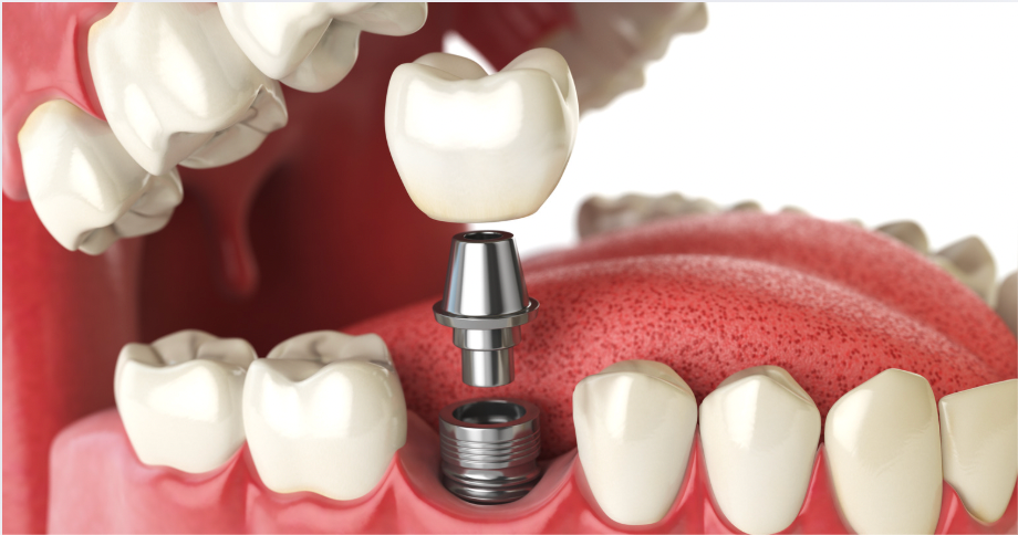 How Long Do Dental Implants Last Compared to Other Tooth Replacement Options?