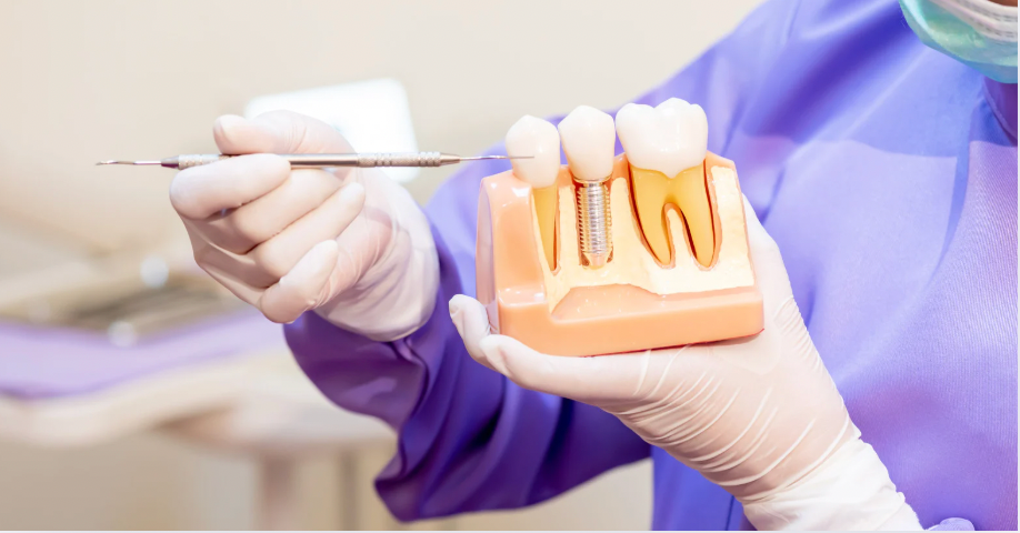 What Is the Process for Getting Dental Implants?