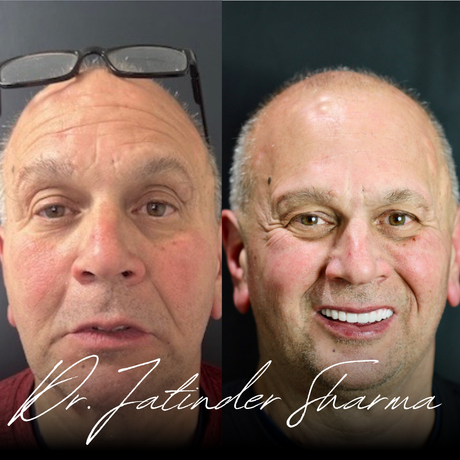 A before and after photo of a man 's face by dr. jatinder sharma