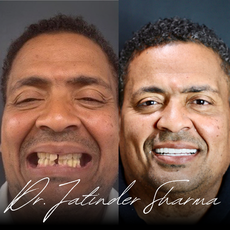 A before and after photo of a man with missing teeth