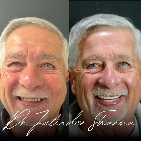 A before and after photo of a man 's face by dr. jatinder sharma