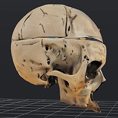 This skull shows a
post-mortem opening that I
chose to preserve. However,
I decided to remove some
sutures, as they are not needed
for facial reconstruction. Victoria Kayser-Cuny