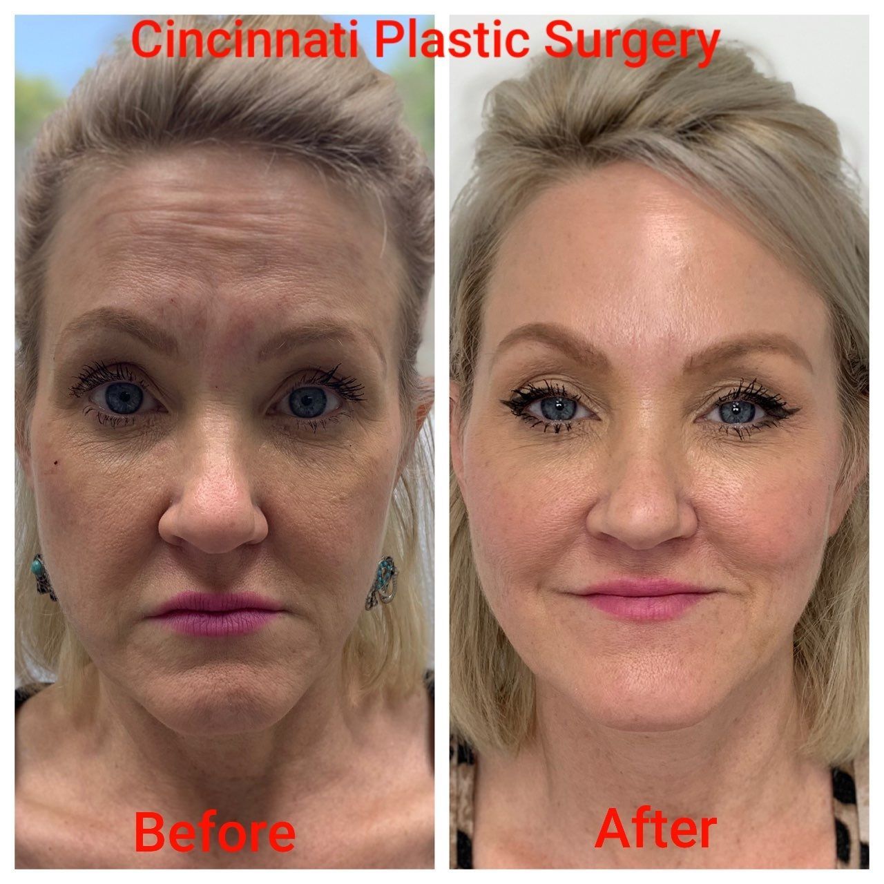 Silhouette InstaLift Pure Beauty Med Spa