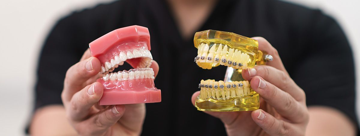 braces vs clear aligners for kids