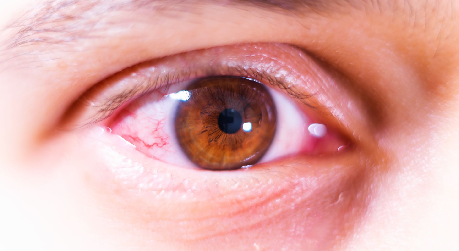 Irritated Brown Eye — Pocatello, ID — Eyecare Of Southeast Idaho