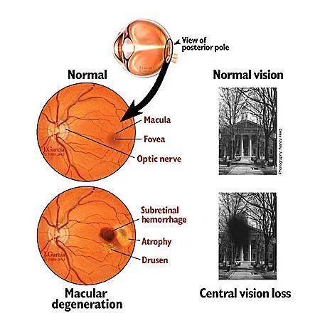 Macular Degeneration Diagram — Pocatello, ID — Eyecare Of Southeast Idaho Macular Degeneration Diagram — Pocatello, ID — Eyecare Of Southeast Idaho