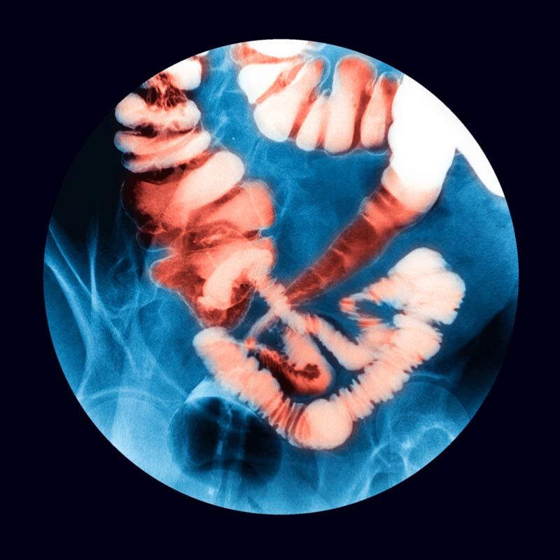 Fluoroscopic examination of the Lower gastrointestinal (GI) Tract, Barium enema exam (BE), Inflammatory bowel disease (IBD)
