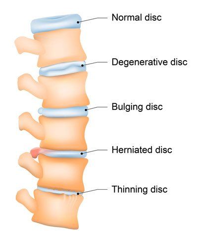 Types of Chiropractic Treatments