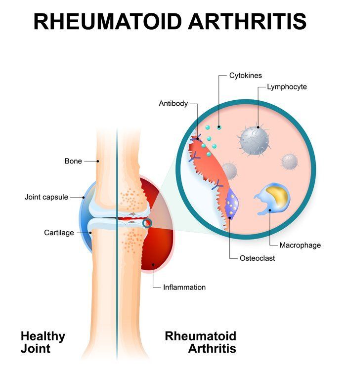 Rheumatoid Arthritis Remedy in Kingston NY from Dr. Louis Granirer Holistic Chiropractor