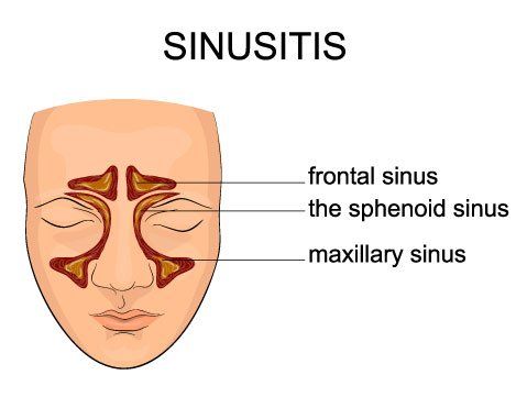 Sinusitis Remedy in Kingston Ulster County NY