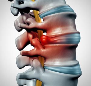 Herniated Disc Treatment NY - Dr. Louis Granirer Holistic Chiropractor
