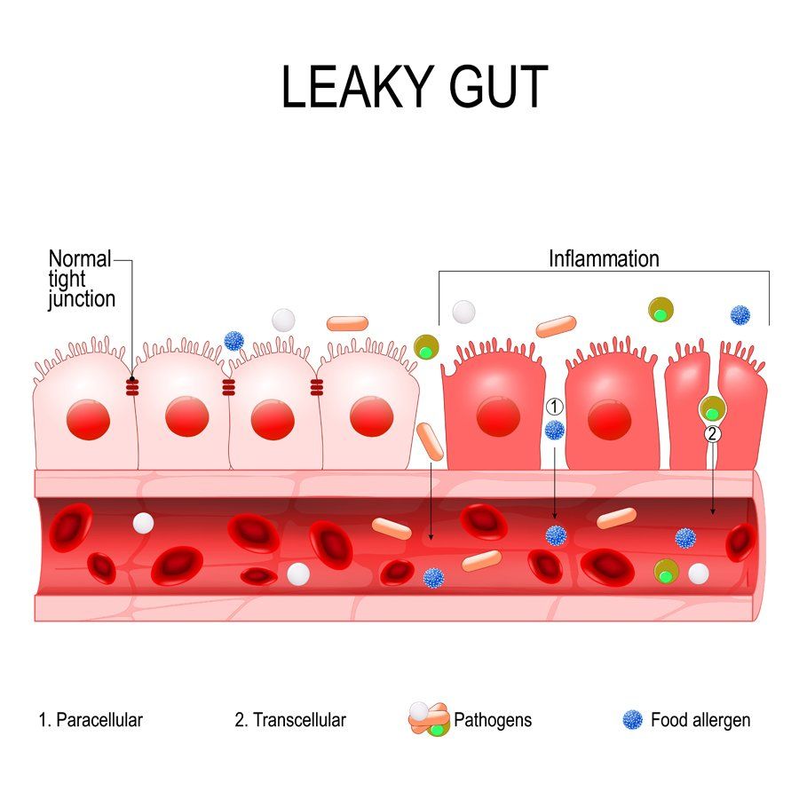 What is Leaky Gut Syndrome? Find Your Leaky Gut Syndrome Remedy at the Holistic Chiropractic Center in Kingston, Ulster County NY 12401