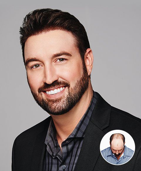 hair balding services